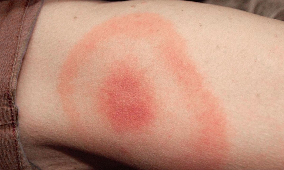 Lyme bull's eye rash